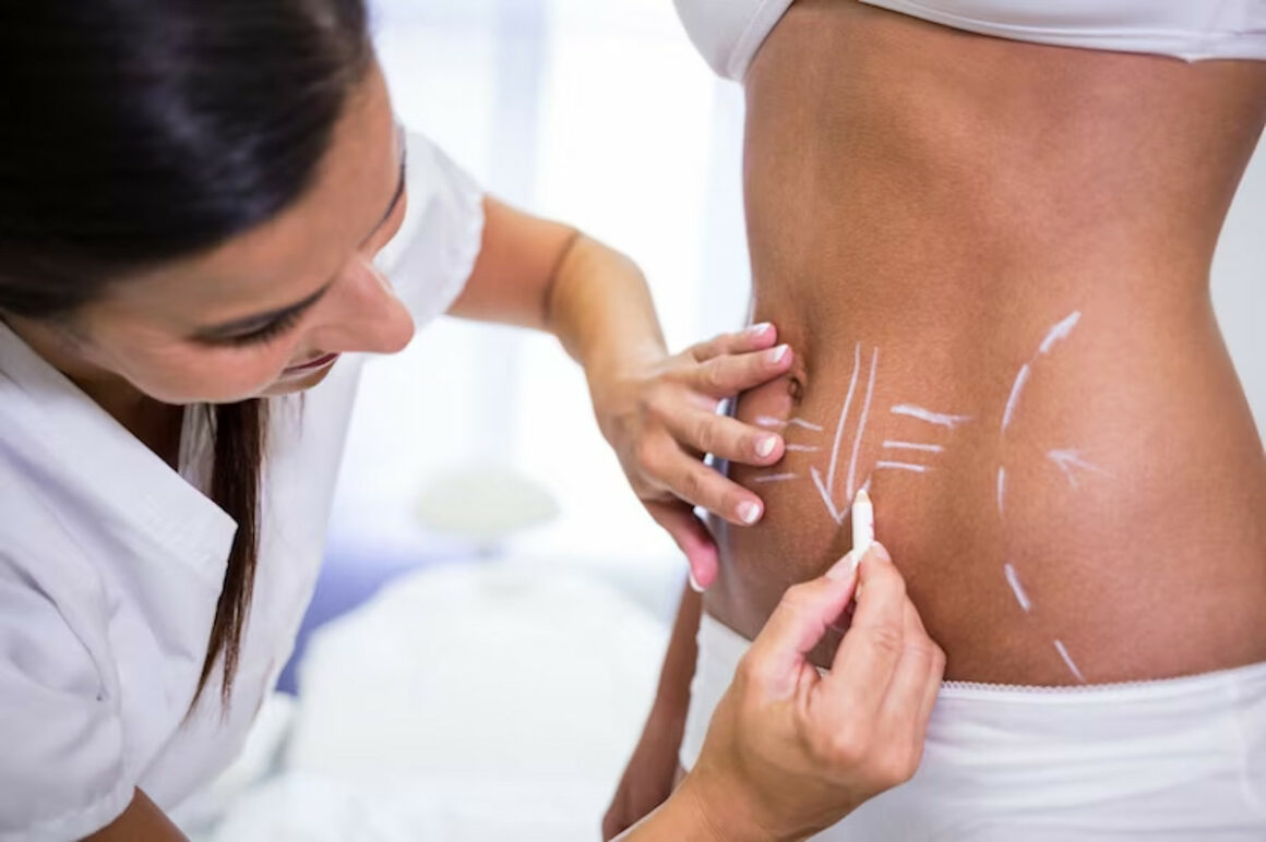 abdominoplastie
