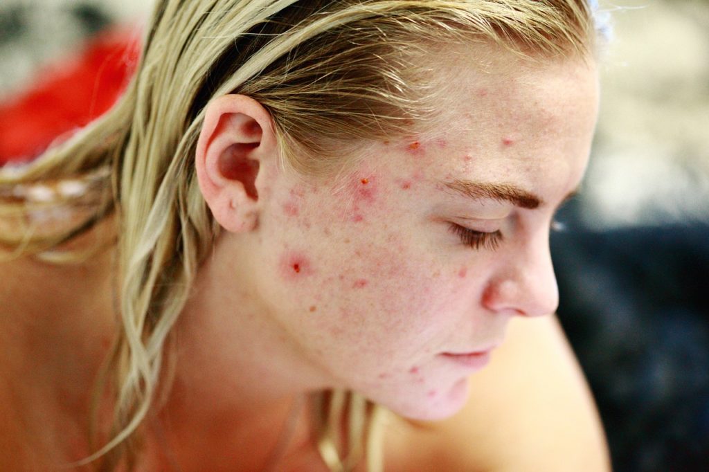 soigner l’acné