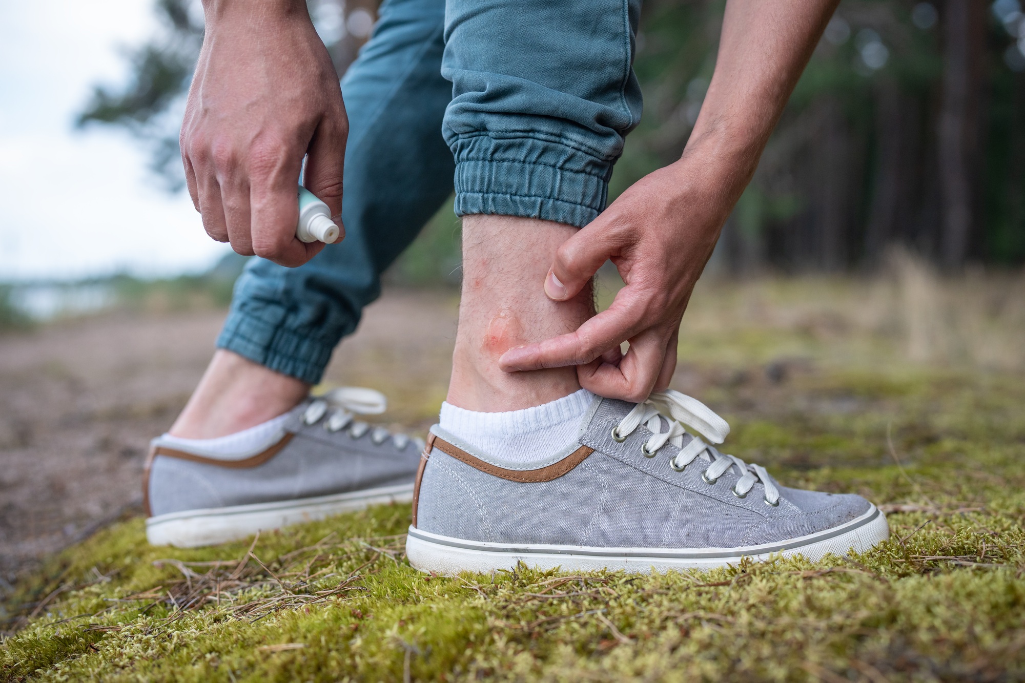 Eczéma pieds